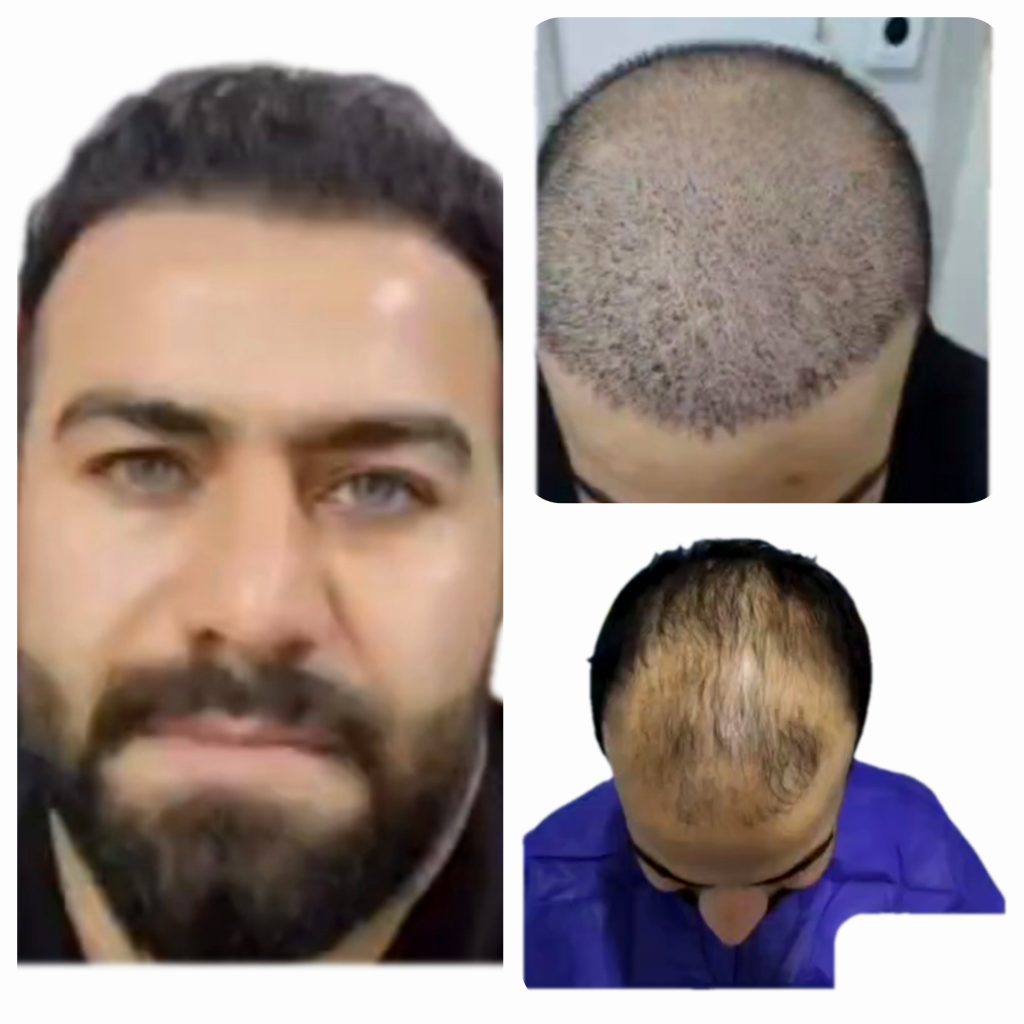 تصویر مقایسه‌ای منتشرشده در گالری کاشت مو آرتان، نمونهٔ 2