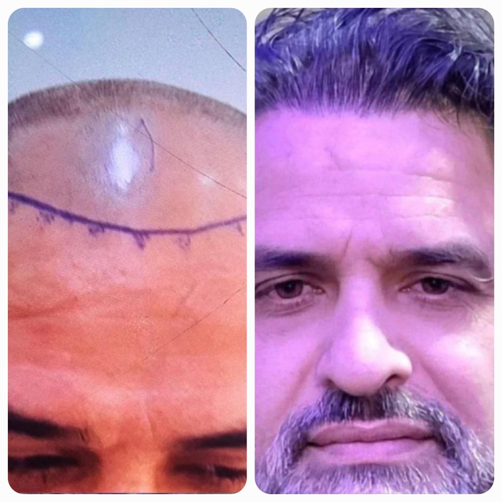 تصویر مقایسه‌ای منتشرشده در گالری کاشت مو آرتان، نمونهٔ 3