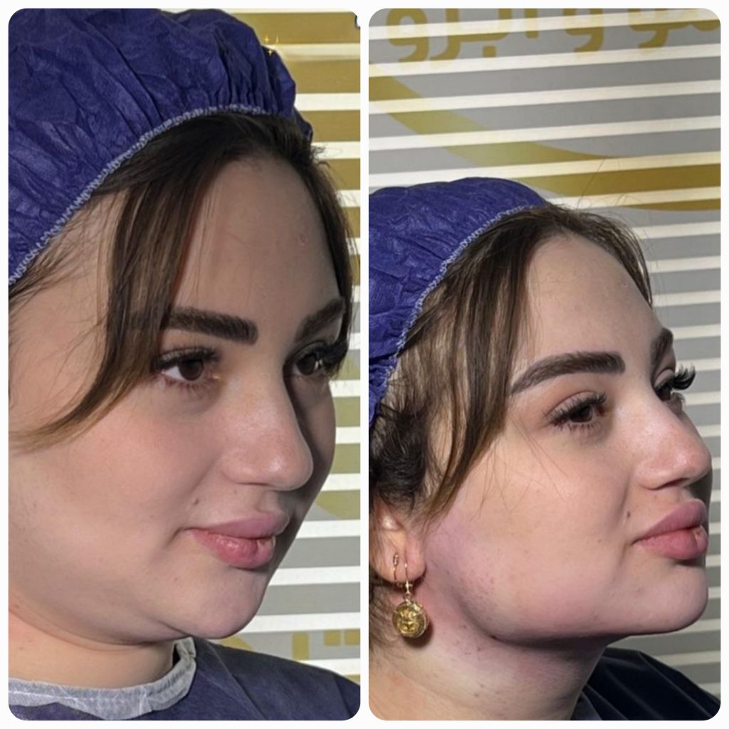 تصویر مقایسه‌ای منتشرشده در گالری جوانسازی صورت آرتان، نمونهٔ 4