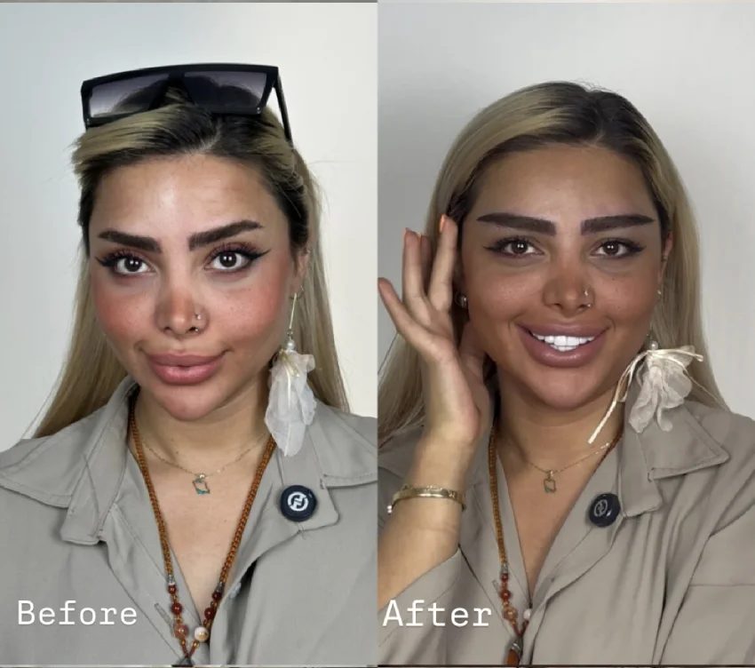 تصویر قبل و بعد کاشت ابرو منتشرشده در گالری آرتان